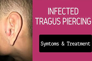 Infected Tragus Piercing – A Complete Guide